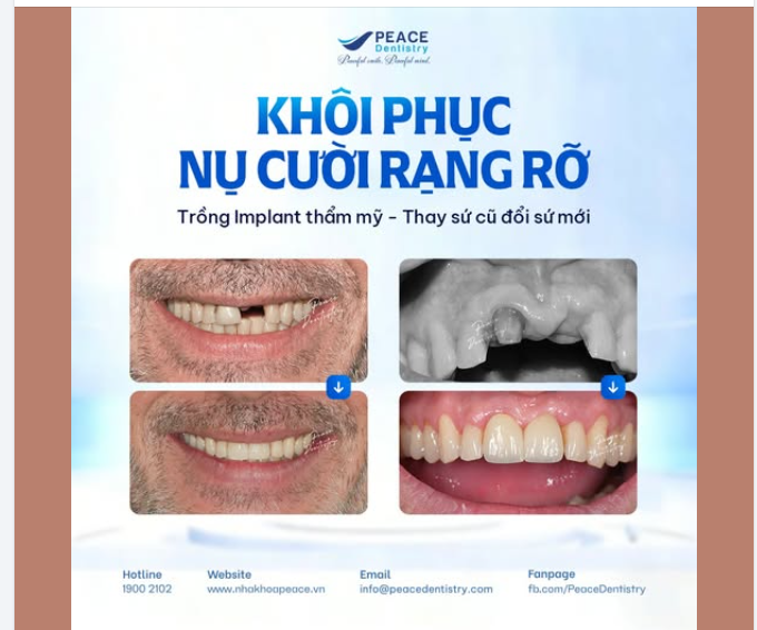Phục hồi chức năng ăn nhai và tính thẩm mỹ tự nhiên cho vùng răng cửa luôn đòi hỏi sự tỉ mỉ và tay nghề vững vàng của bác sĩ điều trị.