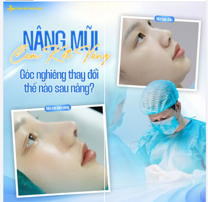 GÓC NGHIÊNG THAY ĐỔI THẾ NÀO SAU NÂNG MŨI CAM KẾT VÀNG?