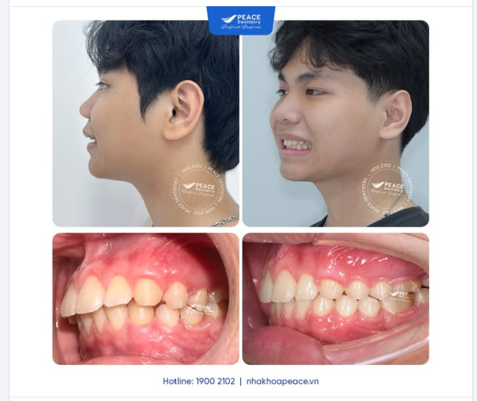 NIỀNG RĂNG ĐÚNG THỜI ĐIỂM: CẢI THIỆN GÓC NGHIÊNG  KHỚP CẮN