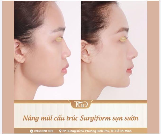 Nâng mũi cấu trúc sụn sườn - giải pháp cho sống mũi gồ, lõm bẩm sinh, kém liền mạch
