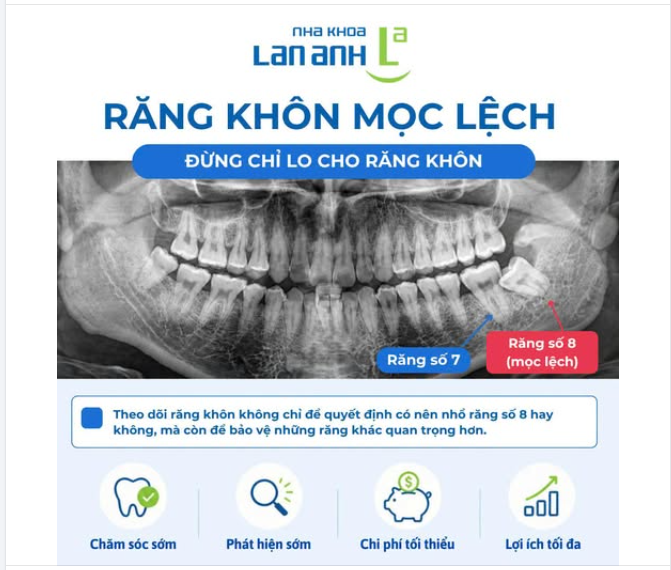 Răng khôn mọc lệch, đừng chỉ lo cho răng khôn