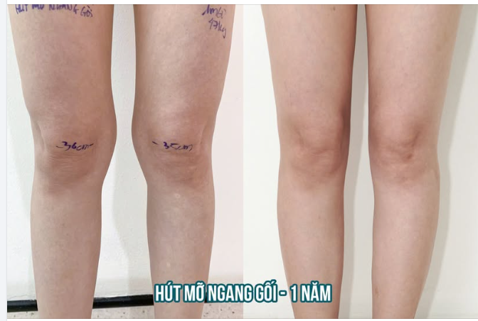 ĐÔI CHÂN ĐẸP, ĐỪNG BỎ QUÊN ĐƯỜNG NÉT QUANH GỐI