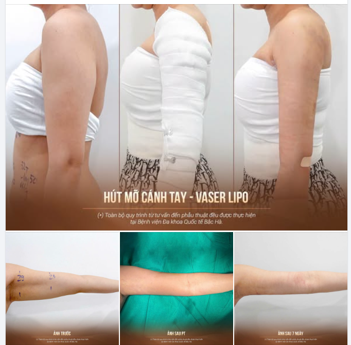 SAU HÚT MỠ CÁNH TAY – ĐƯỜNG NÉT ĐÃ BẮT ĐẦU THAY ĐỔI