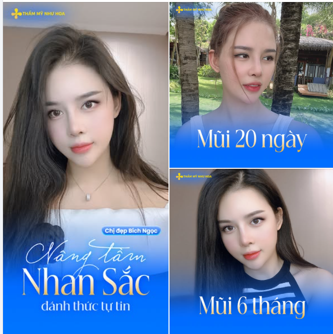 6 tháng sau nâng mũi Golden Line, chị đẹp Bích Ngọc vẫn dành nhiều lời khen cho diện mạo mới.