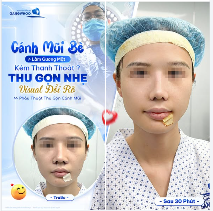 CÁNH MŨI BÈ LÀM GƯƠNG MẶT KÉM THANH THOÁT