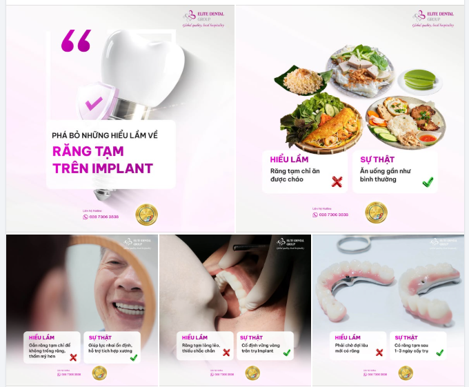 RĂNG TẠM SAU CẤY IMPLANT – “TẠM” VỀ THỜI GIAN, KHÔNG “TẠM” TRONG CÁCH THỰC HIỆN