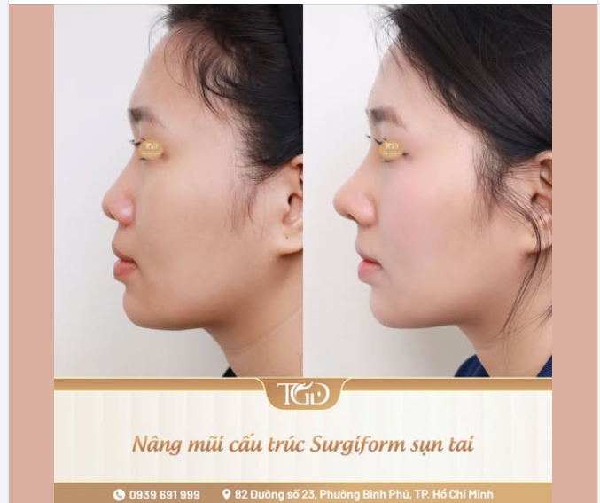 Nhiều người nghĩ nâng mũi cấu trúc sụn tai thường nghĩ sụn tai được dùng để “nâng cao sống mũi”.