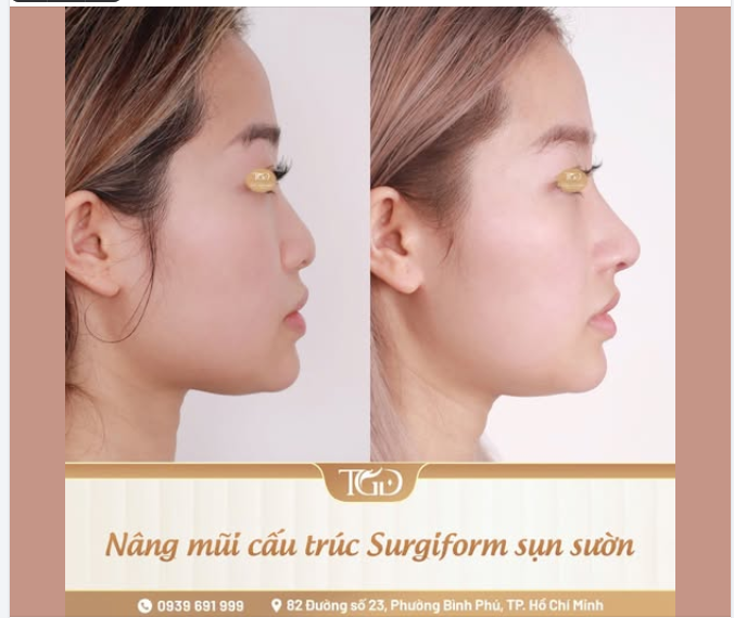 Từ ĐẦU MŨI CỤP đến DÁNG MŨI BAY thanh thoát - Bác sĩ đã thay đổi những gì?