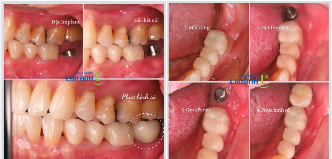 COMBO IMPLANT CAO CẤP – ĐẦU TƯ MỘT LẦN, HƯỚNG ĐẾN GIÁ TRỊ BỀN LÂU!