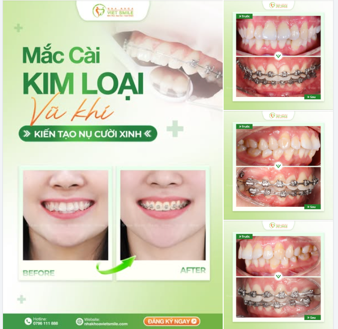 30 TUỔI VÀ HÀNH TRÌNH LỘT XÁC VỚI MẮC CÀI KIM LOẠI TẠI VIET SMILE