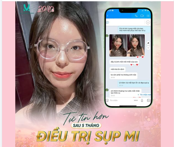 TỰ TIN HƠN SAU 5 THÁNG ĐIỀU TRỊ SỤP MI