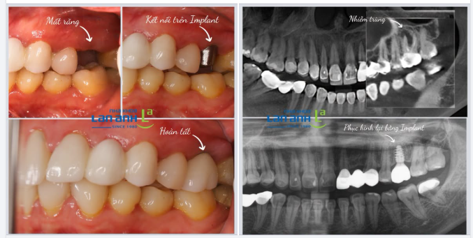 Nobel TiUltra - Công nghệ bề mặt hỗ trợ tích hợp xương, hướng đến phục hình hiệu quả