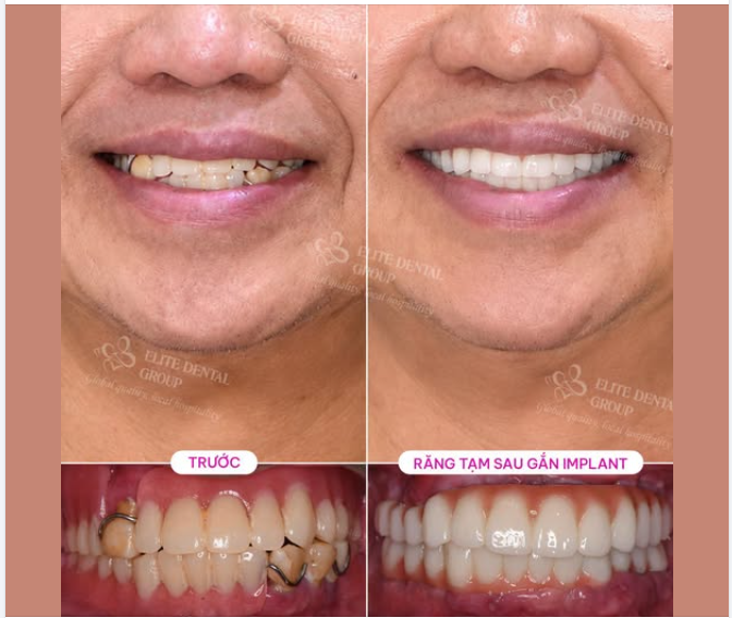 TỪ HÀM THÁO LẮP ĐẾN RĂNG TẠM TRÊN IMPLANT: BƯỚC NGOẶT LỚN THAY ĐỔI CHẤT LƯỢNG SỐNG