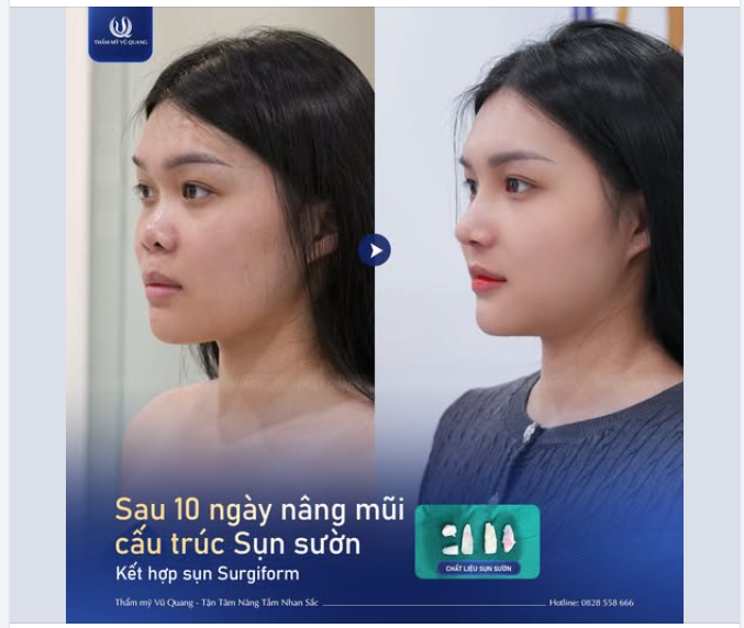 10 NGÀY SAU NÂNG MŨI SỤN SƯỜN- MỘT HÀNH TRÌNH TÁI SINH NHAN SẮC
