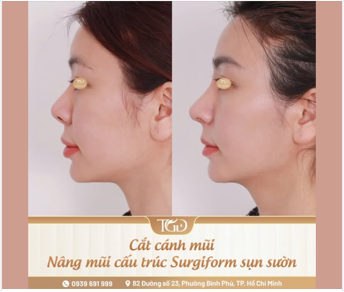 Đầu mũi to, mũi hếch, cánh mũi lệch – Bài toán tái cấu trúc sau phẫu thuật
