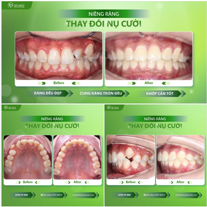 Nhật ký niềng răng của Thanh Tùng, từ những ngày đầu còn khấp khểnh đến khi tháo niềng.