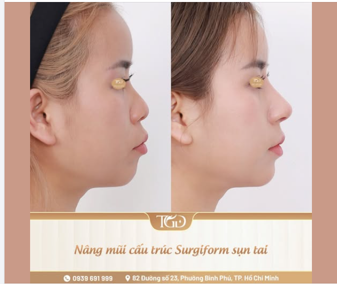 Trong trường hợp da đầu mũi mỏng, mô mềm ít, bác sĩ cần đánh giá tổng quát cấu trúc cũng như tình trạng nền mũi trước khi lựa chọn sử dụng sụn tai trong tạo hình.