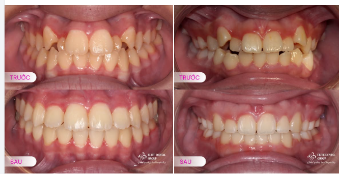 NIỀNG RĂNG CHEN CHÚC: KHÔNG CHỈ ĐỂ ĐẸP