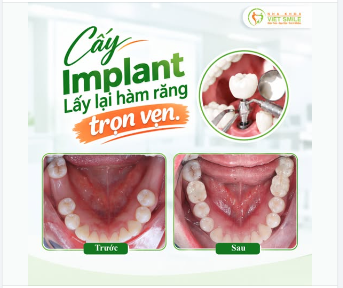 TÌM LẠI CẢM GIÁC ĂN NGON MIỆNG SAU KHI PHỤC HỒI 3 RĂNG HÀM