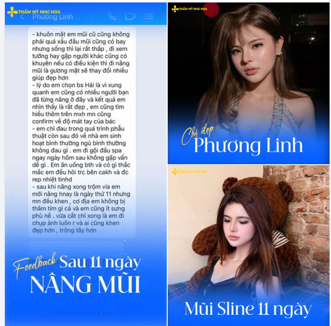 Chị đẹp Phương Linh và màn thăng hạng nhan sắc sau 11 ngày nâng mũi S-line cùng Tiến sĩ Tống Hải