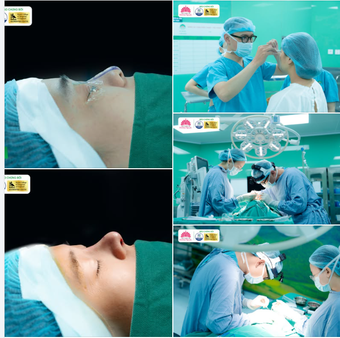 NÂNG MŨI CẤU TRÚC TẠI THẨM MỸ BỆNH VIỆN HỒNG NGỌC