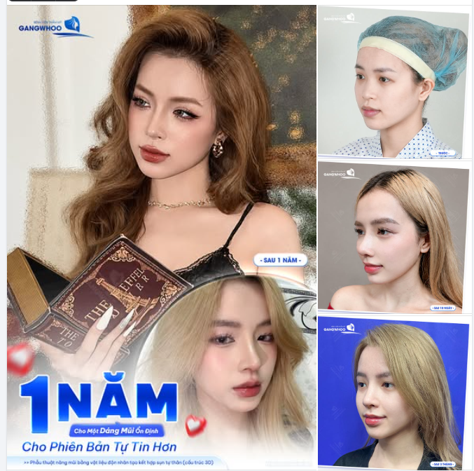 1 NĂM CHO MỘT DÁNG MŨI ỔN ĐỊNH