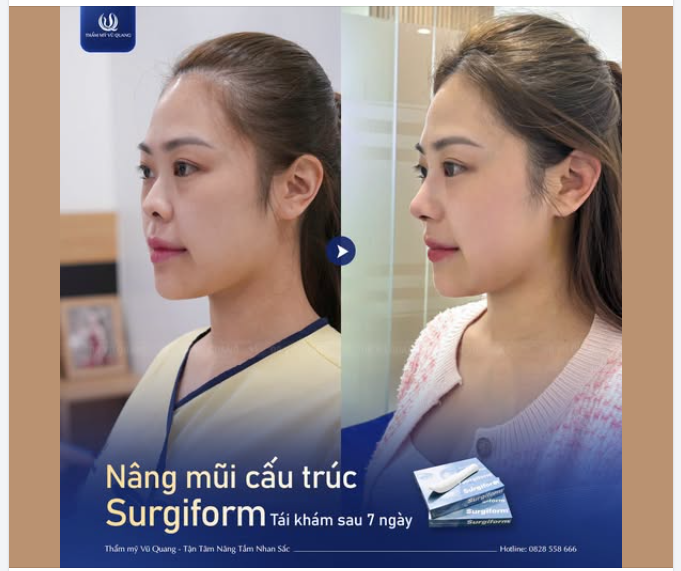 GÓC NGHIÊNG THẦN THÁNH SAU 7 NGÀY NÂNG MŨI SURGIFORM!
