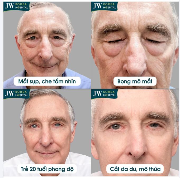 C.ẮT DA THỪA, BỎ MỠ BÁC SĨ JW GIÚP ÔNG NGOẠI U70 NGƯỜI MỸ CẢI LÃO 20 TUỔI TỨC THÌ