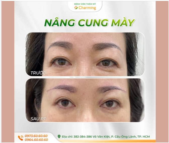 DA CHÙNG CHE NẾP MÍ - NÂNG CUNG MÀY CÓ PHẢI LỰA CHỌN HỢP LÝ?