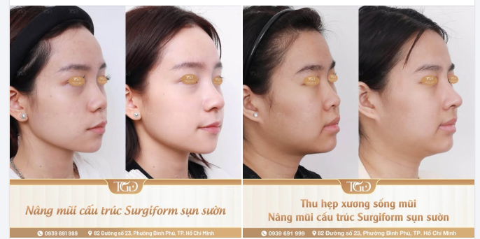 Định hình sống mũi hài hòa, thanh thoát với Nâng mũi cấu trúc sụn sườn + Thu hẹp xương sống mũi