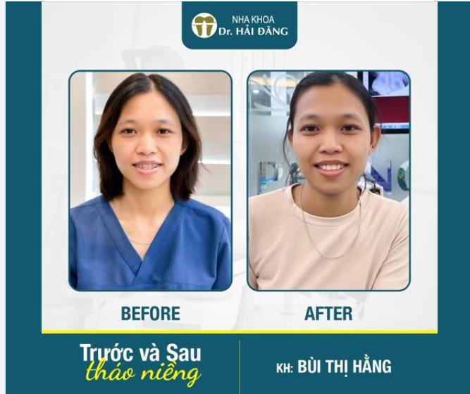 CHÚC MỪNG KHÁCH HÀNG BÙI THỊ HẰNG CHÍNH THỨC THÁO NIỀNG!