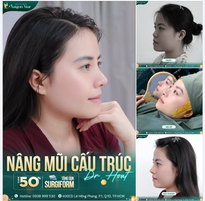KHÁCH HÀNG GEN Z THÀNG CÔNG "RESET VISUAL" CÙNG NÂNG MŨI CẤU TRÚC DR. HOẠT 
