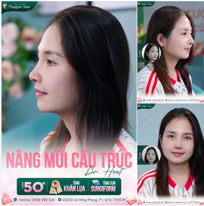 NÂNG MŨI CẤU TRÚC - THIẾT KẾ MŨI ĐẸP "ĐỘC BẢN"