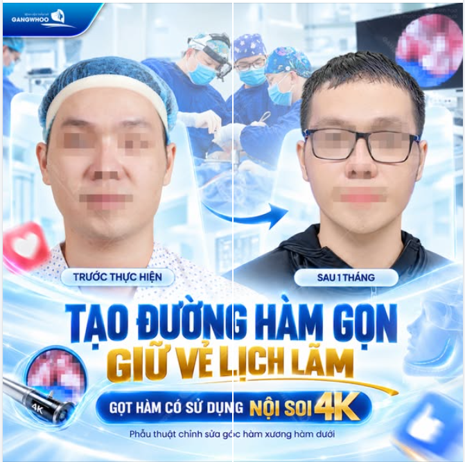 TẠO ĐƯỜNG HÀM GỌN, GIỮ VẺ LỊCH LÃM - GỌT HÀM CÓ SỬ DỤNG NỘI SOI 4K