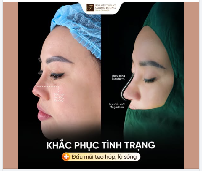 KHẮC PHỤC TÌNH TRẠNG ĐẦU MŨI TEO HÓP, LỘ SỐNG