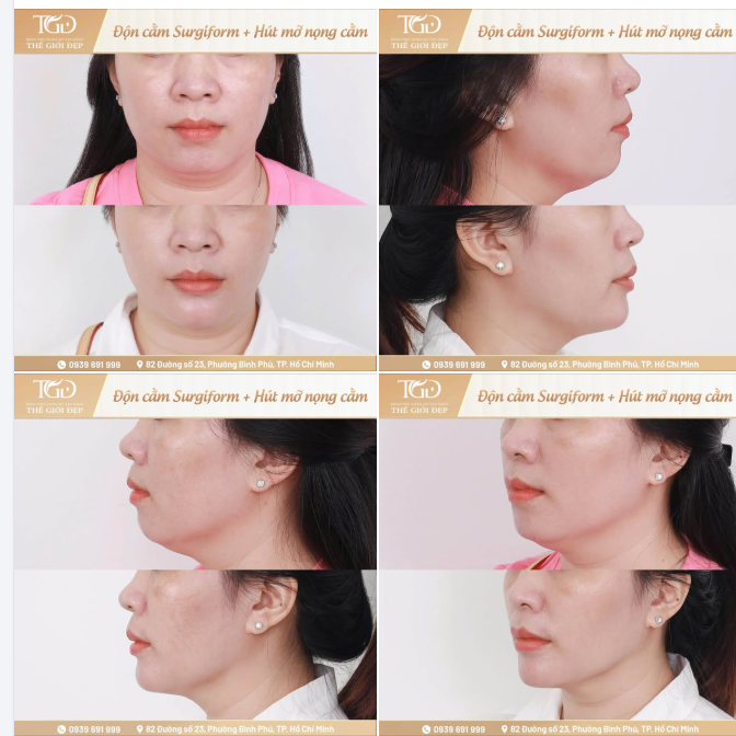 Cằm lẹm, nọng cằm nhiều: Vì sao chỉ độn cằm chưa chắc đã đủ đẹp?