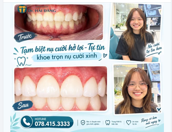 TẠM BIỆT NỤ CƯỜI HỞ LỢI – TỰ TIN KHOE NỤ CƯỜI RẠNG RỠ!