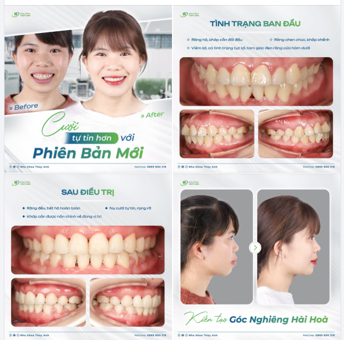 NIỀNG RĂNG GIẢM HÔ - CASE ĐIỀU TRỊ TRÊN NỀN BỆNH NHÂN VIÊM NHA CHU, TIÊU XƯƠNG KẼ RĂNG