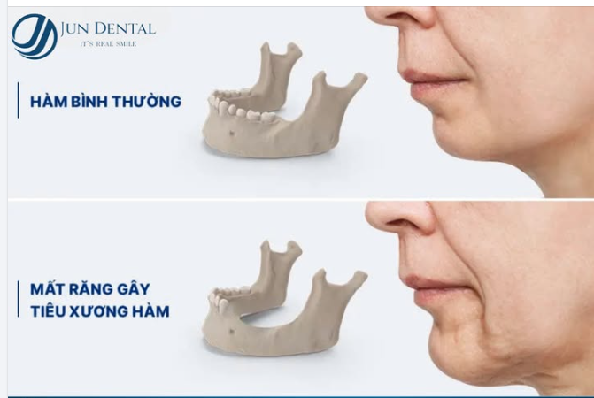 MẤT RĂNG – KHÔNG CHỈ LÀ VẤN ĐỀ THẨM MỸ!