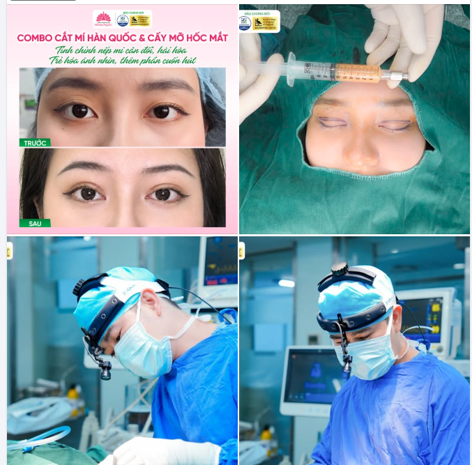 COMBO CẮT MÍ HÀN QUỐC CẤY MỠ HỐC MẮT - KHẮC PHỤC MÍ LÓT, HỐC MẮT TRŨNG, LỆCH LÕM HAI BÊN