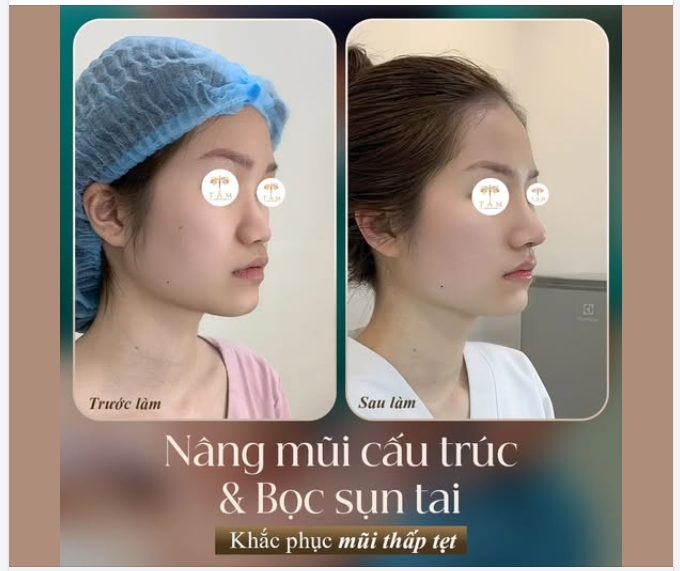 NÂNG MŨI CẤU TRÚC KẾT HỢP BỌC SỤN TAI TẠI TẤM