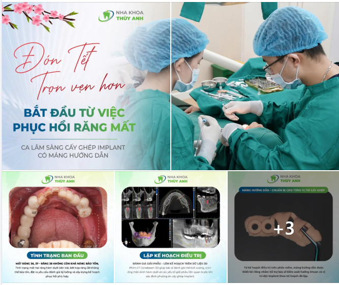 MẤT RĂNG HÀM TRƯỚC THỀM TẾT: ĐIỀU GÌ CẦN ĐƯỢC QUAN TÂM?