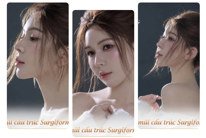 Khi nhắc đến nâng mũi sụn sườn, nhiều Khách hàng thường quan tâm đến chất liệu được sử dụng.