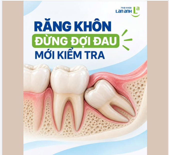 Răng khôn chưa đau, có cần theo dõi không?
