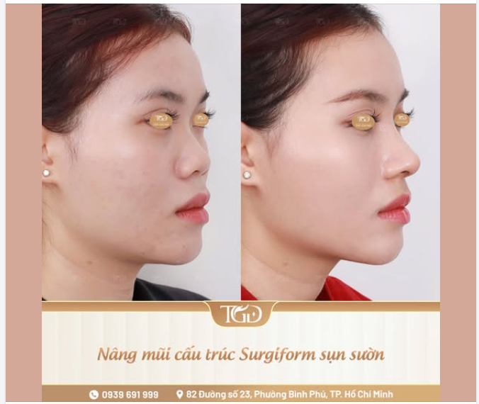 Để cải thiện tổng thể dáng mũi, từ nền mũi thấp, cánh mũi bè đến cấu trúc mũi yếu, Bác sĩ đã điều chỉnh những yếu tố nào để tạo nên đường nét thanh thoát hơn như hiện tại?