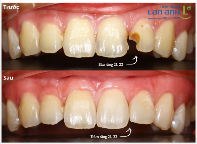 TRÁM RĂNG CỬA – NHỎ THÔI, NHƯNG KHÔNG HỀ ĐƠN GIẢN