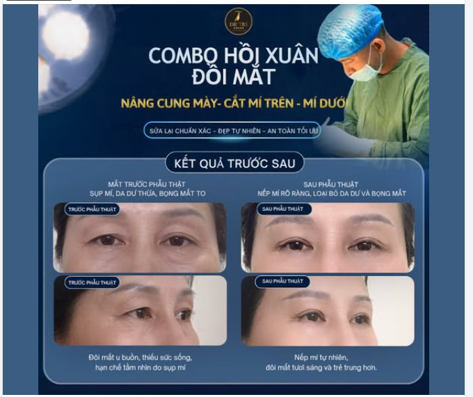 TẠM BIỆT ĐÔI MẮT U BUỒN, SỤP MÍ