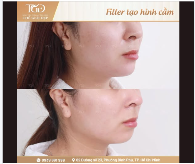 Những hiểu lầm phổ biến về FILLER CẰM không phải ai cũng biết?