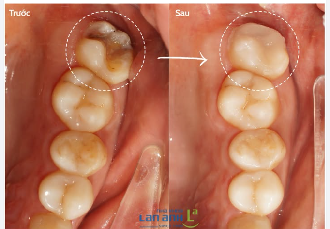 ONLAY SỨ - PHỤC HÌNH RĂNG, HẠN CHẾ MÀI MÔ RĂNG