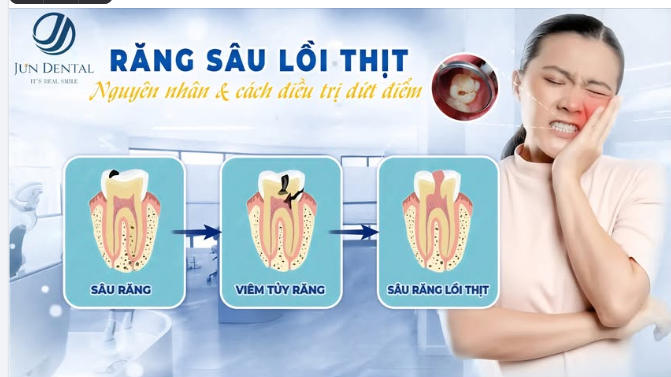 RĂNG SÂU LỖI THỊT – ĐỪNG ĐỂ ĐAU MỚI ĐIỀU TRỊ!